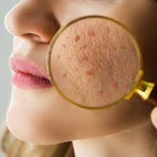 Postpartum Acne Treatment