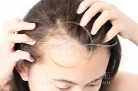 Postpartum Hair Loss Timeline