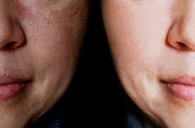 Postpartum Hyperpigmentation Fade