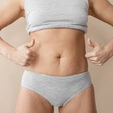 Postpartum Stretch Mark Fade